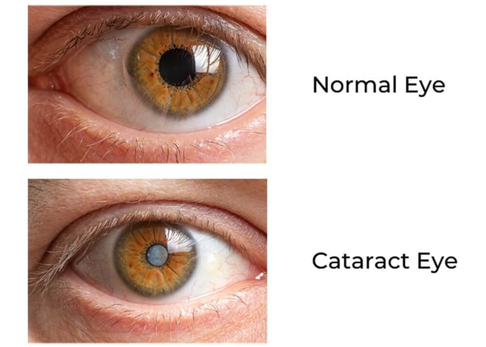 cataract
